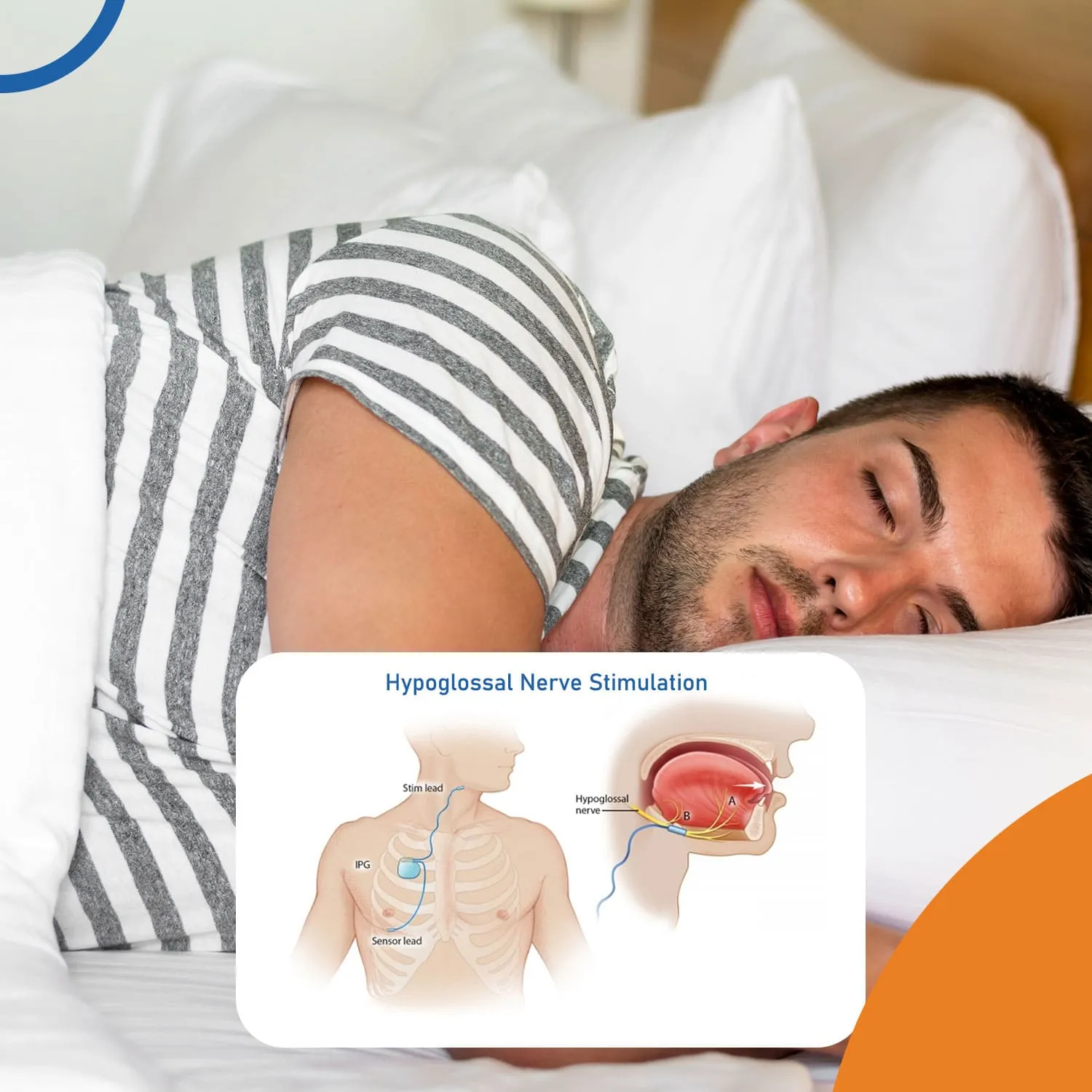 how does hypoglossal nerve stimulation work