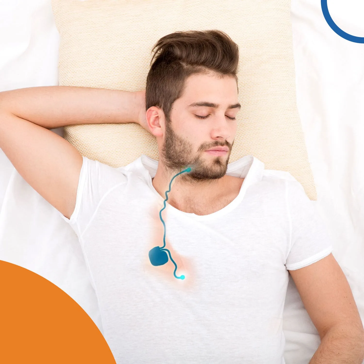 what is hypoglossal nerve stimulation