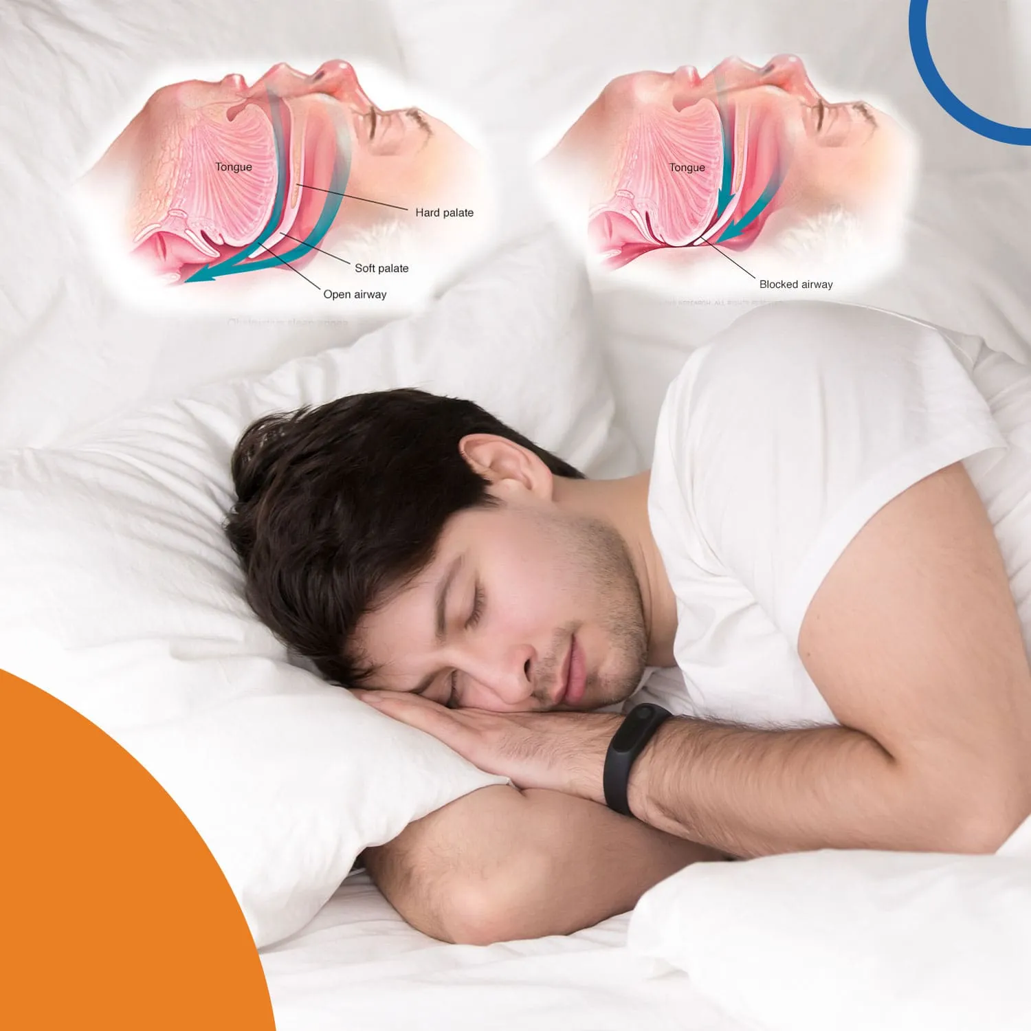 why is hypoglossal nerve stimulation used to treat obstructive sleep apnea